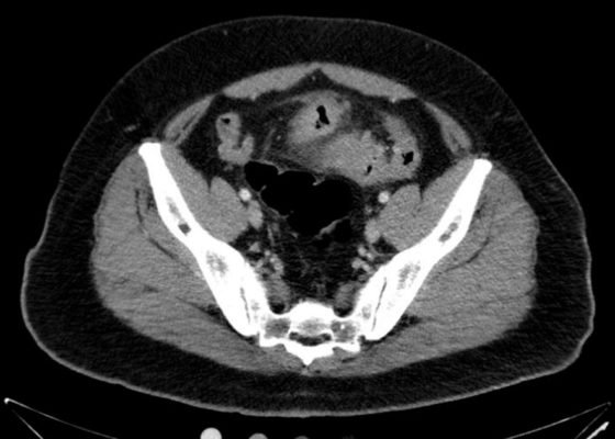 Sigmoid Diverticulitis Complicated by Colovesical Fistula Presenting with Pneumaturia 6 Creative Commons images
