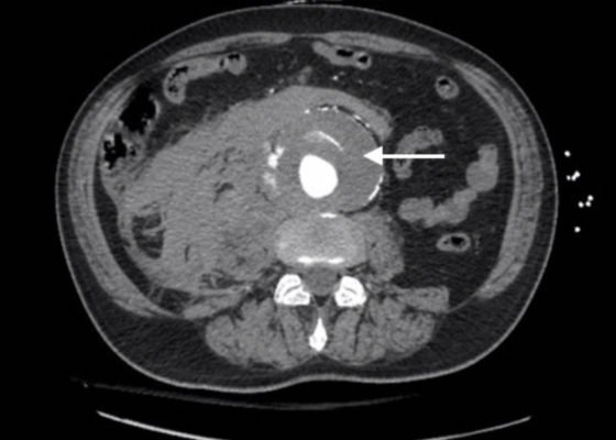 Ruptured AAA Presenting with Unresponsiveness and Cardiac Arrest 8 Creative Commons images