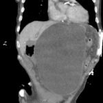 Gastric Volvulus 2 Creative Commons images