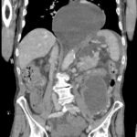 Gastric Volvulus 3 Creative Commons images