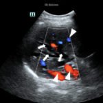 Point-of-Care Ultrasound to Evaluate Intrahepatic Biliary Stent Function 1 Creative Commons images