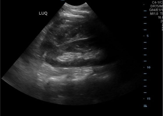 FAST Exam to Diagnose Subcapsular Renal Hematoma 12 Creative Commons images