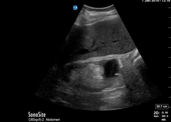 Hemorrhagic Renal Cyst 2 Creative Commons images