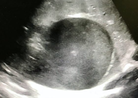 Right Upper Quadrant Pain in a World Explorer 14 Creative Commons images