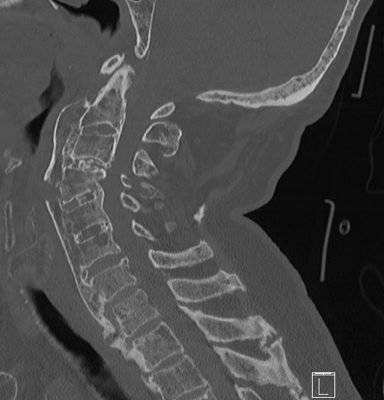 Case Report of the Unusual Presentation of Stridor in an Elderly Patient Following a Cervical Fracture 8 Creative Commons images