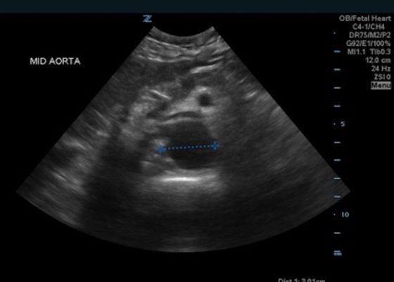 Bilateral Common Iliac Artery Aneurysm 4 Creative Commons images
