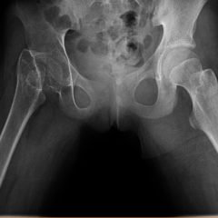 Case Report of Untreated Pediatric Femoral Neck Fracture with Osteopenia 7 Creative Commons images