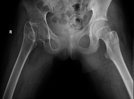 Case Report of Untreated Pediatric Femoral Neck Fracture with Osteopenia 14 Creative Commons images