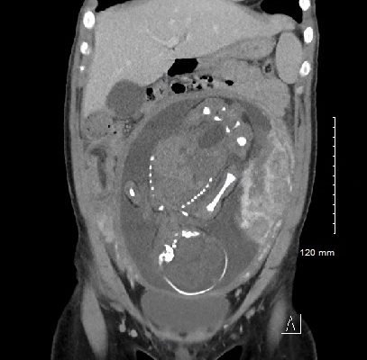 Meckel’s Diverticulum Causing Small Bowel Intussusception in Third Trimester Pregnancy 2 Creative Commons images