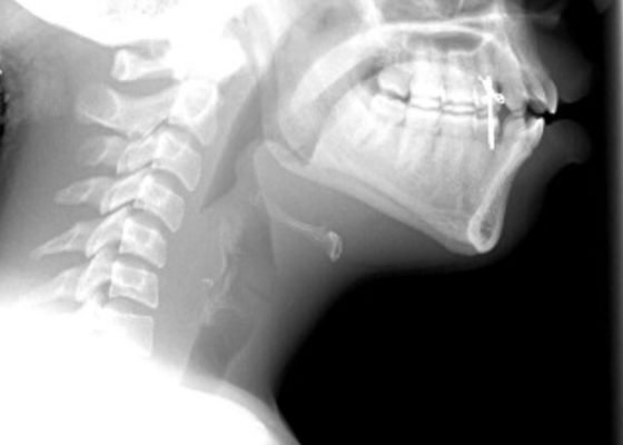 Case Report: Acute Supraglottitis 4 Creative Commons images