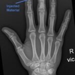 High-Pressure Hand Injection Injury Case Report 2 Creative Commons images