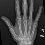 High-Pressure Hand Injection Injury Case Report 1 Creative Commons images