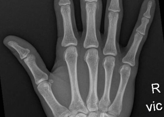 High-Pressure Hand Injection Injury Case Report 16 Creative Commons images