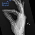 High-Pressure Hand Injection Injury Case Report 4 Creative Commons images