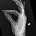 High-Pressure Hand Injection Injury Case Report 3 Creative Commons images