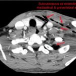 Necrotizing Fasciitis and Mediastinitis after Wisdom Tooth Extraction: A Case Report 4 Creative Commons images