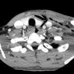 Necrotizing Fasciitis and Mediastinitis after Wisdom Tooth Extraction: A Case Report 2 Creative Commons images