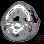 Necrotizing Fasciitis and Mediastinitis after Wisdom Tooth Extraction: A Case Report 3 Creative Commons images