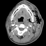 Necrotizing Fasciitis and Mediastinitis after Wisdom Tooth Extraction: A Case Report 1 Creative Commons images