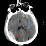 A Case Report of Epidural Hematoma After Traumatic Brain Injury 2 Creative Commons images
