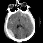 A Case Report of Epidural Hematoma After Traumatic Brain Injury 1 Creative Commons images