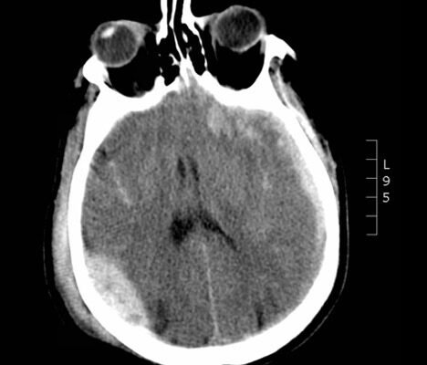 A Case Report of Epidural Hematoma After Traumatic Brain Injury 6 Creative Commons images