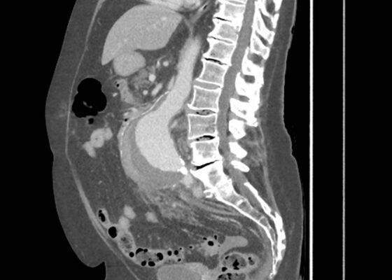 Caught on CT! The Case of the Hemodynamically Stable Ruptured Abdominal Aortic Aneurysm 2 Creative Commons images