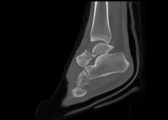 Case Report: Talar Neck Fracture 12 Creative Commons images