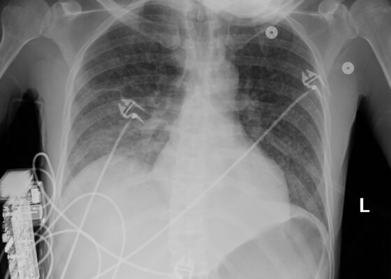 A Case Report on Miliary Tuberculosis in Acute Immune Reconstitution Inflammatory Syndrome 14 Creative Commons images