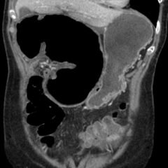 Subtalar Dislocation Jetem