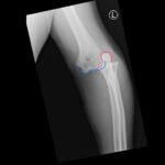 DRUJ Elbow Xray, AP, Annotated. JETem 2020