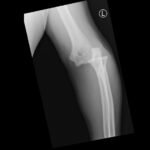 DRUJ Elbow Xray, AP. Unannotated. JETem 2020
