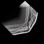 DRUJ Elbow Xray, Lateral, Post Reduction, Annotated. JETem 2020