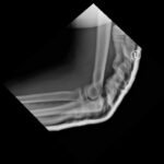 DRUJ Elbow Xray, Lateral, Post Reduction. Unannotated. JETem 2020