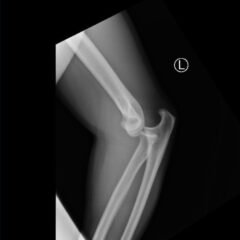 DRUJ Elbow Xray, Lateral. Unannotated. JETem 2020