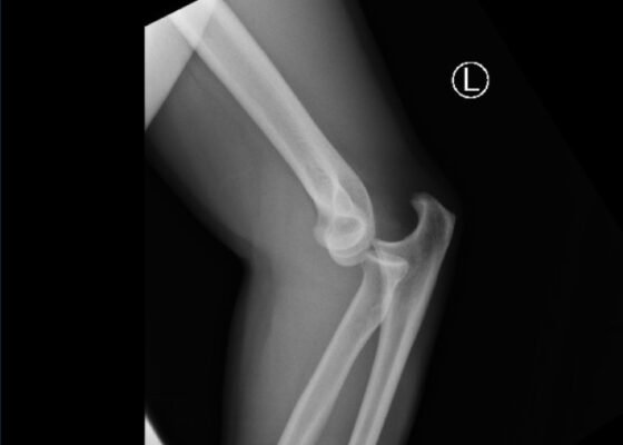 Case Report of Distal Radioulnar Joint and Posterior Elbow Dislocation 10 DRUJ Elbow Xray, Lateral. Unannotated. JETem 2020