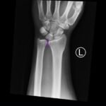 DRUJ Wrist Xray, AP, Annotated. JETem 2020