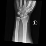 DRUJ Wrist Xray, AP. Unannotated. JETem 2020