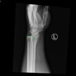 DRUJ Wrist Xray, Lateral, Annotated. JETem 2020