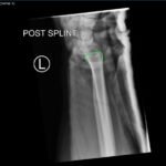 DRUJ Wrist Xray, Lateral, Post Reduction, Annotated. JETem 2020