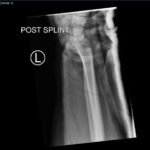 DRUJ Wrist Xray, Lateral, Post Reduction. Unannotated. JETem 2020