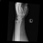 DRUJ Wrist Xray, Lateral. Unannotated. JETem 2020