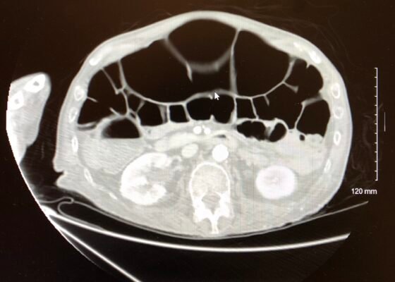 A Case Report of Ogilvie's Syndrome in a 58-year-old Quadriplegic 8 Creative Commons images