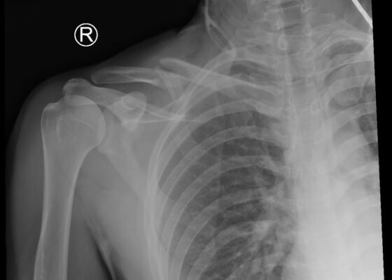 Adult Clavicular Fracture Case Report 8 Creative Commons images