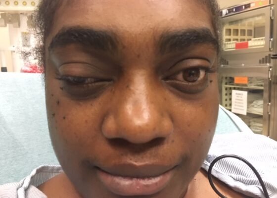 A Case Report of Posterior Communicating Artery Aneurysm Presenting as Cranial Nerve 3 Palsy in a Young Female Patient with Migraines 2 Creative Commons images