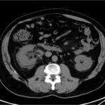 Case Report: Not Your Typical Kidney Stone 1 Creative Commons images