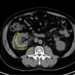 Case Report: Not Your Typical Kidney Stone 3 Creative Commons images