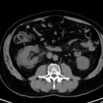 Case Report: Not Your Typical Kidney Stone 2 Creative Commons images