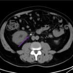 Case Report: Not Your Typical Kidney Stone 5 Creative Commons images
