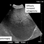 A Case Report of Glycogenic Hepatopathy 2 Creative Commons images